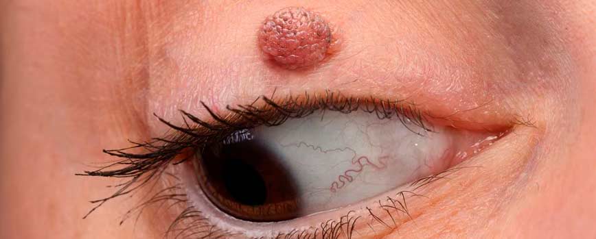 ¿Por qué salen verrugas en los ojos?
