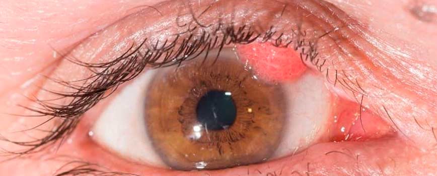 ¿Cómo quitar verrugas debajo del ojo?