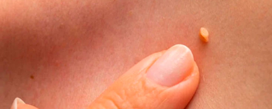 ¿Qué tipos de verrugas salen en las axilas?