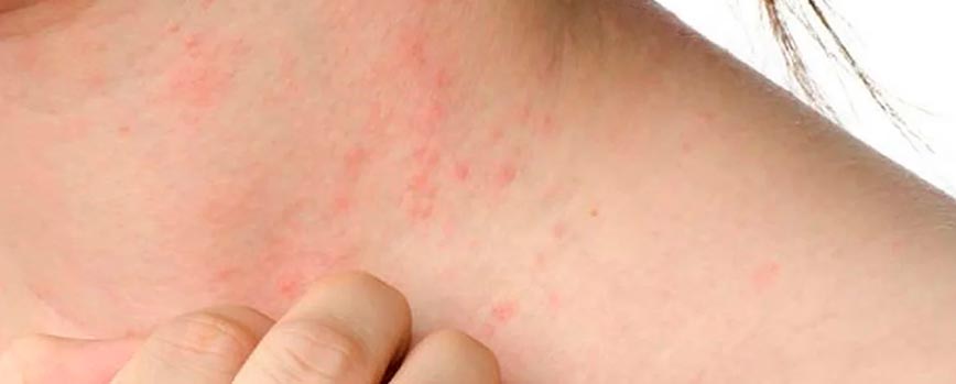 Causas de la dermatitis atópica