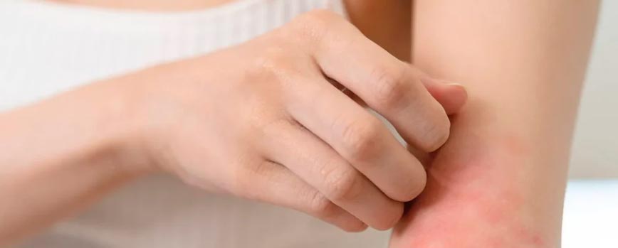 Principales síntomas de la dermatitis atópica