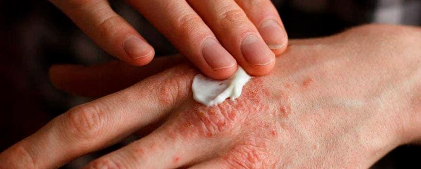 Tratamiento de la dermatitis atópica