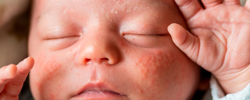 Causas de la dermatitis atópica en bebés