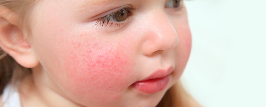 Diferencias entre la piel de un recién nacido y un adulto que ayudan a entender la dermatitis atópica en la cara de bebés