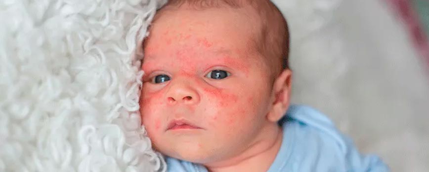 ¿Cómo saber si mi bebé tiene dermatitis atópica?