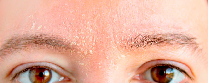 ¿Qué es la dermatitis seborreica?