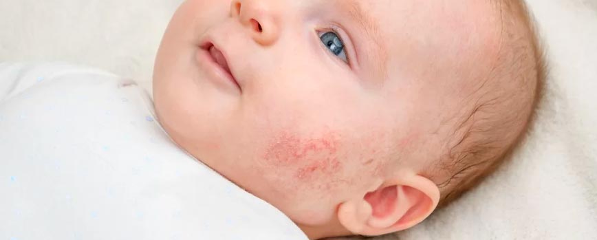 Causas de la dermatitis seborreica en bebés