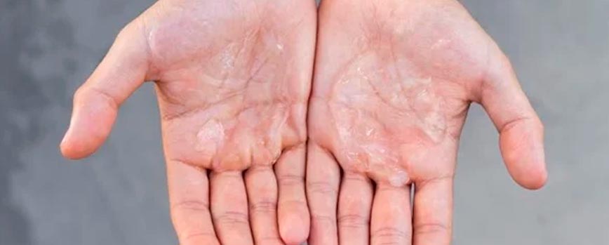 Causas de la dishidrosis