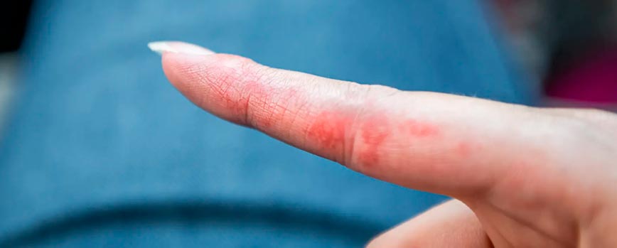 Síntomas de la dishidrosis que te ayudarán a identificarla