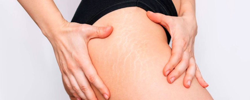 ¿Cómo son las estrías en las piernas?