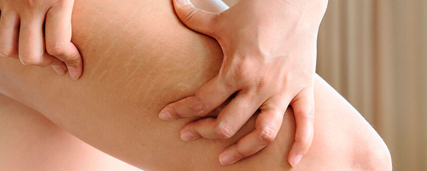 ¿Cuáles son las 10 causas más comunes de las estrías en las piernas?