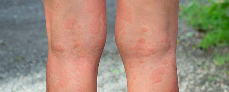 Principales síntomas de un sarpullido rojo en las piernas