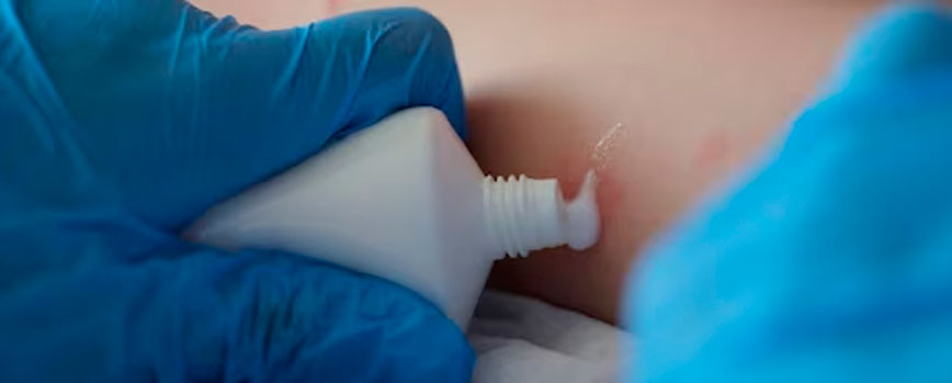 Cómo tratar el sarpullido en las piernas