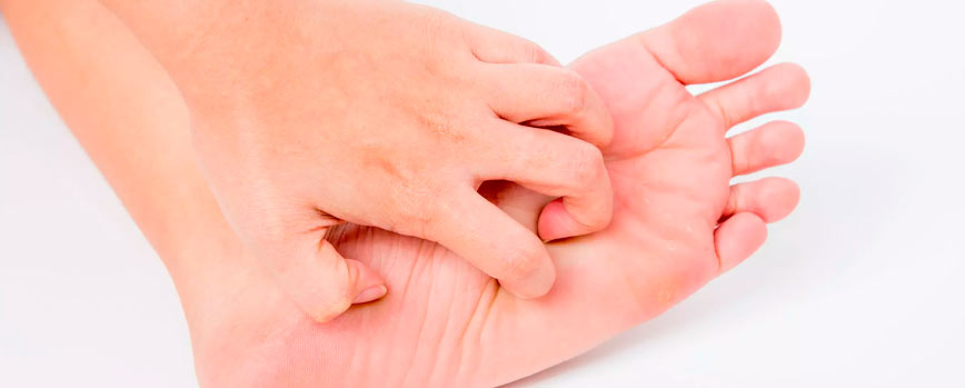 ¿Cuáles son los síntomas de un sarpullido en los pies más habituales?