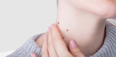 Tipos de verrugas en la cara y cómo quitarlas | Blog Druni
