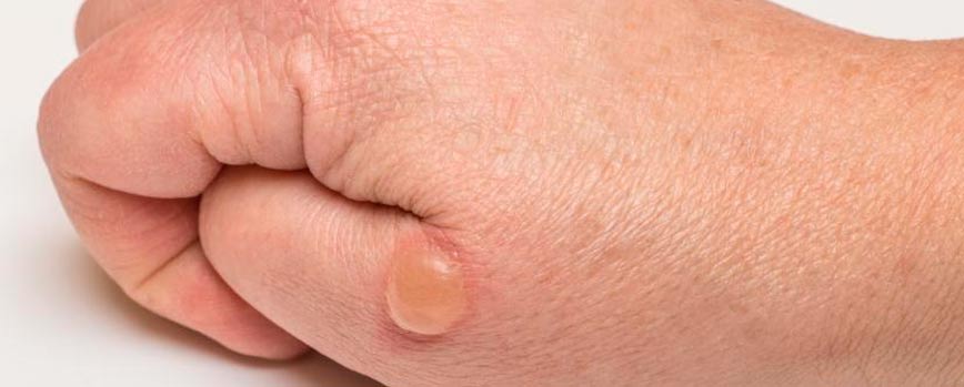 ¿Por qué salen las ampollas en la piel?