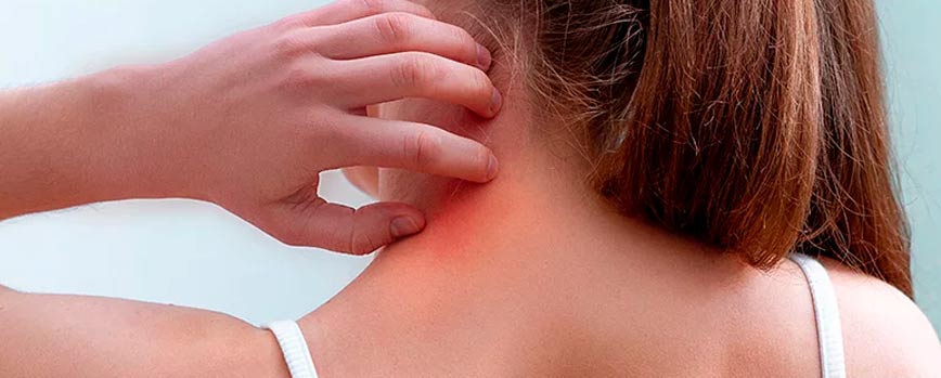 Antes de nada, ¿Qué es la psoriasis capilar?