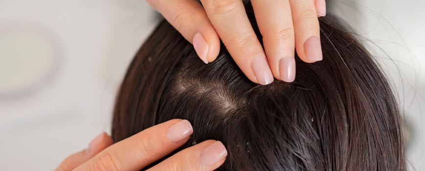 ¿Cómo saber si tengo psoriasis en el cuero cabelludo?
