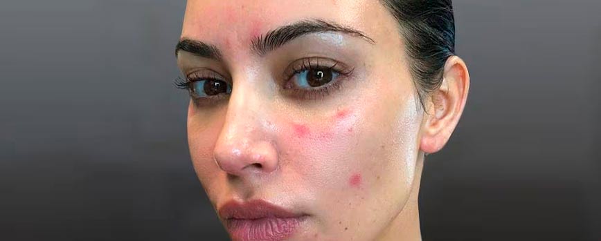 Síntomas de la psoriasis en la cara