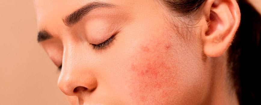Consejos para el tratamiento de la psoriasis en la cara