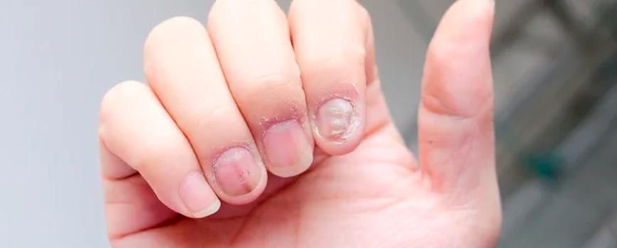 ¿Qué es la psoriasis en las uñas?