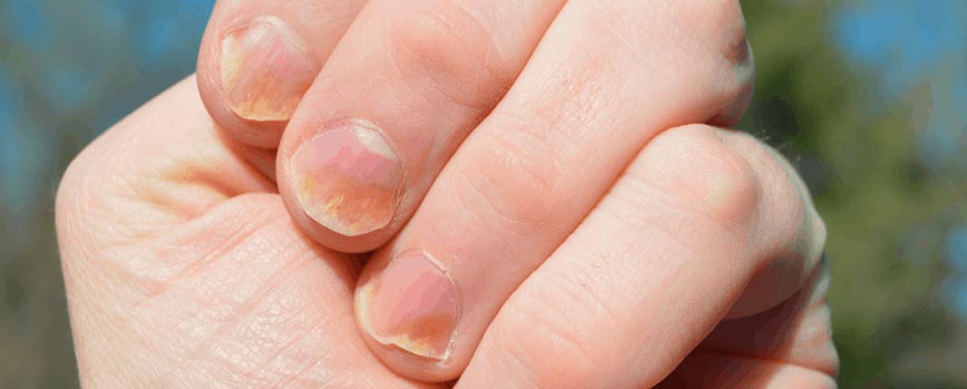 Causas de la psoriasis en las uñas