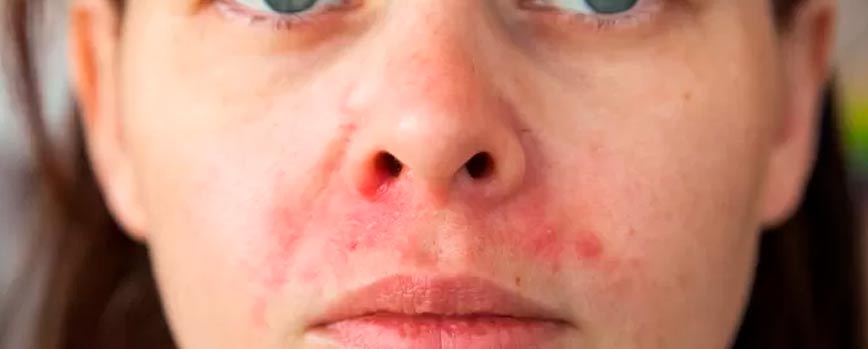 ¿Cuáles son las causas de la dermatitis seborreica en la cara?