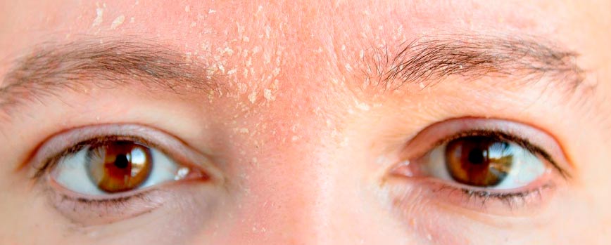 Síntomas de la dermatitis seborreica en la cara