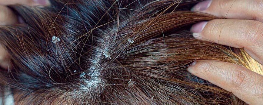 ¿Qué es la dermatitis seborreica en el cuero cabelludo?