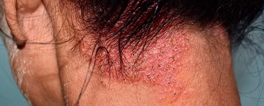Principales síntomas de la dermatitis seborreica en el cuero cabelludo