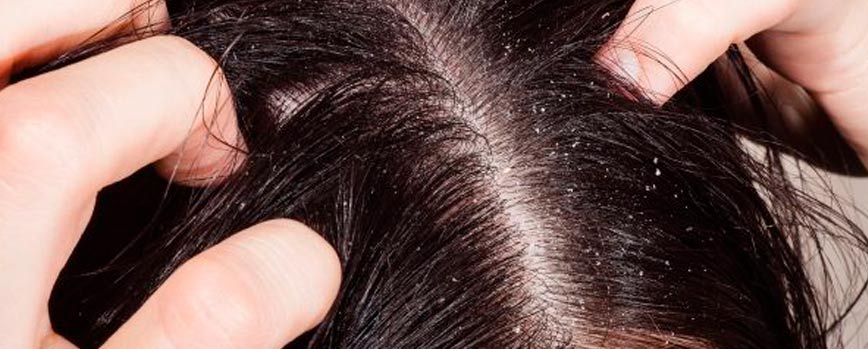 Causas de la dermatitis seborreica en el cuero cabelludo: ¿por qué aparece?