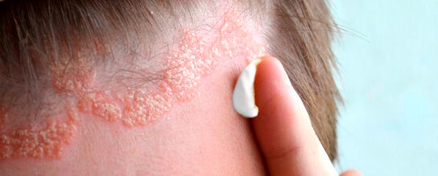 ¿Cómo tratar la dermatitis seborreica en el cuero cabelludo?