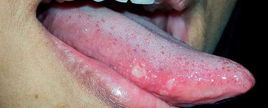 ¿Por qué salen llagas en la lengua?