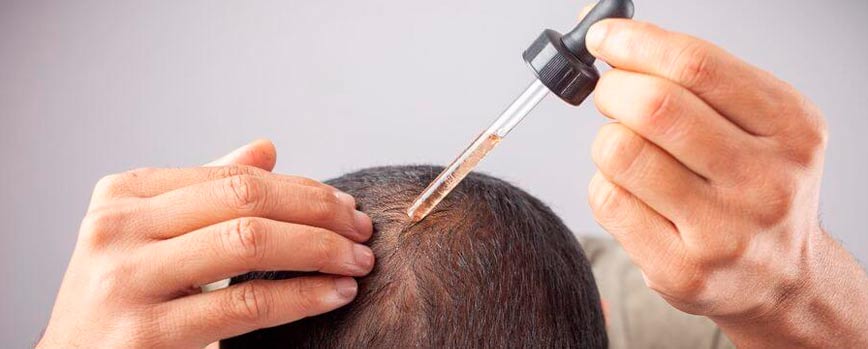 ¿Qué es el minoxidil?