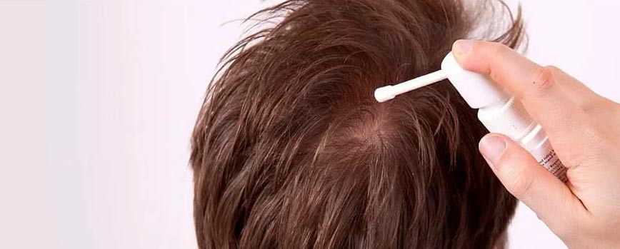 ¿Cómo aplicar minoxidil?