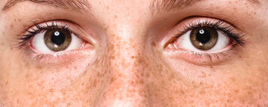 ¿Por qué salen las pecas?