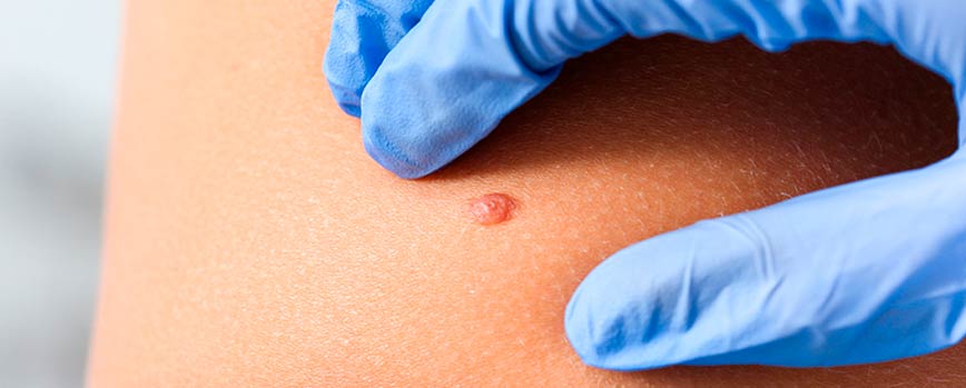 Existen diferentes tipos de lunares cancerígenos