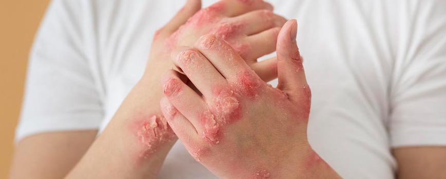 ¿Por qué sale la psoriasis?
