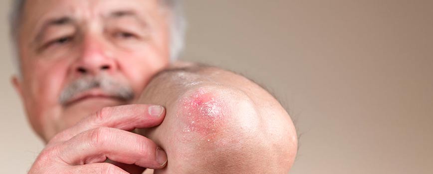 ¿Cómo empieza la psoriasis?