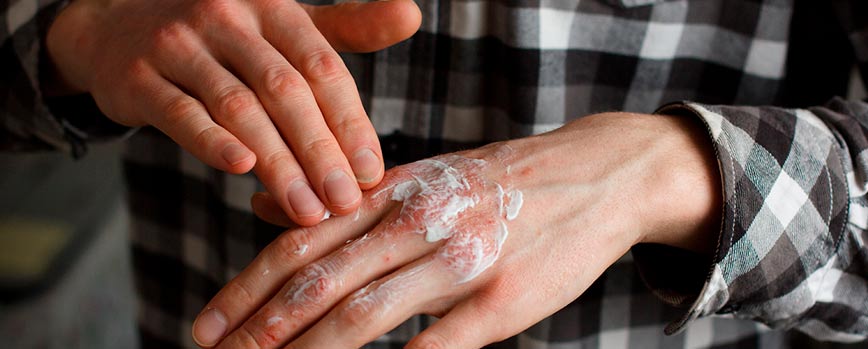 ¿Cómo tratar la psoriasis?