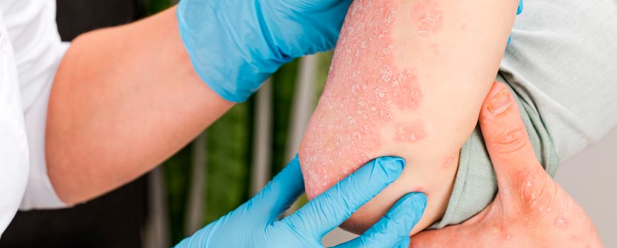 ¿Cómo tratar la psoriasis en los codos y aliviar los síntomas?