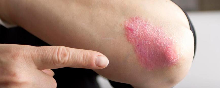 ¿Cuáles son las causas de la psoriasis en los codos?