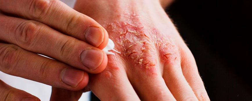 Tratamiento de la psoriasis en las manos