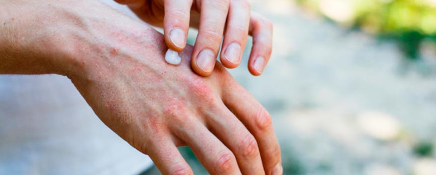 Síntomas de la psoriasis en las manos
