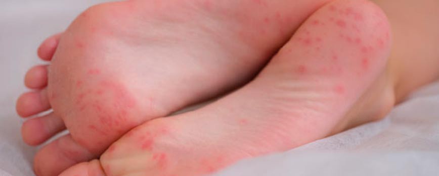 ¿Qué es la psoriasis en los pies?