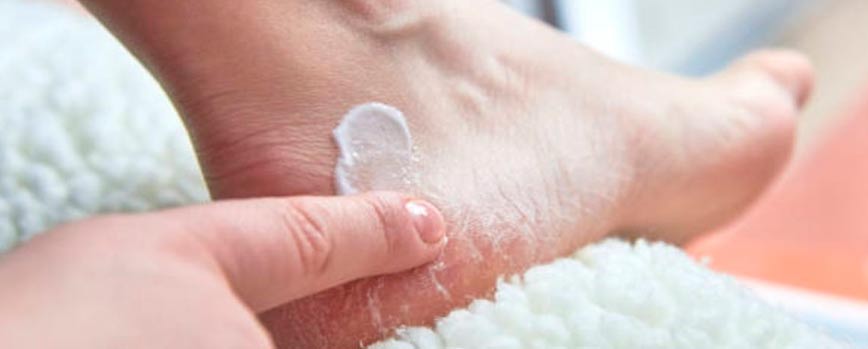 ¿Cómo tratar la psoriasis en los pies?