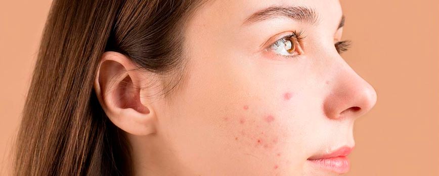 Tipos de espinillas en el rostro que pueden aparecer