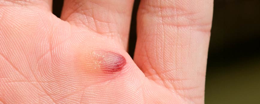 ¿Qué es una ampolla de sangre?