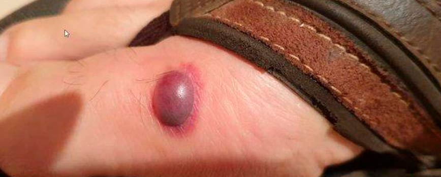 Ampolla de sangre causas