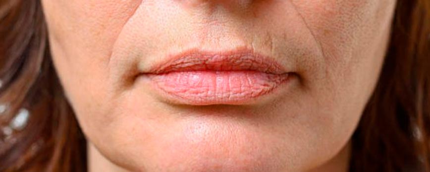 Remedios para las arrugas en el labio superior